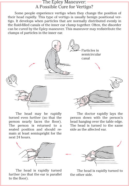 epley_maneuver