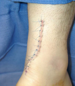 Achilles Tendon 3