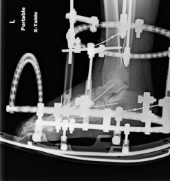 Charcot 2