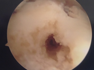 Microfracture, talus (ankle) for growth of fibrocartilage