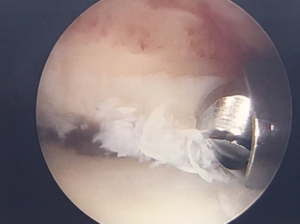 Arthroscopic spur removal, ankle, with power burr