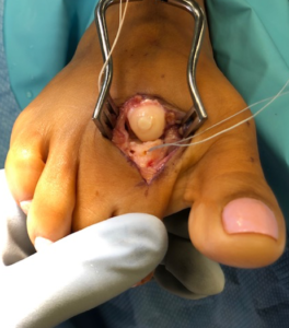 Cartilage defect, repaired with cartilage graft