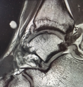 Osteochondral (bone/cartilage) defect on MRI