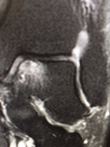 Osteochondral (bone/cartilage) defect on MRI