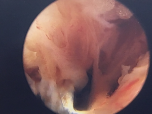 Ankle synovitis (joint lining) arthroscopic removal for chronic inflammation