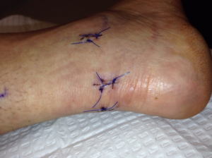 Posterior ankle scope, small incisions healing 