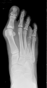 Brachymetatarsia and Polydactyly