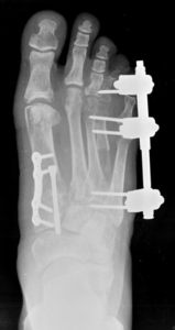 Distraction osteogenesis