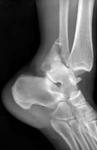 Foot Fracture - Treatment For Foot Fractures In Fairfax, Virginia