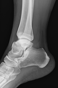 Talus body fracture x-ray