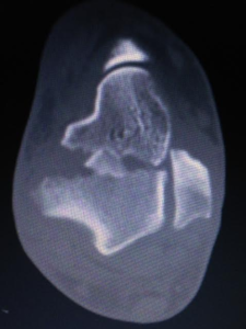 Talus body fracture CT image