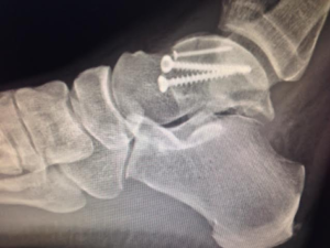 Talus body fracture, repaired