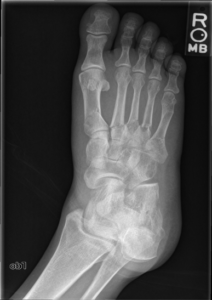 Multiple metatarsal fractures, preoperative