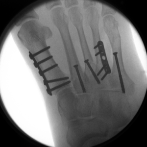 Multiple metatarsal fractures, repaired