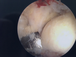 Arthroscopic removal of symptomatic os trigonum causing chronic pain