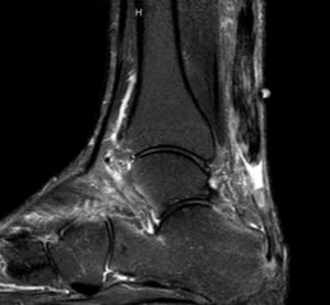 Achilles tendon rupture