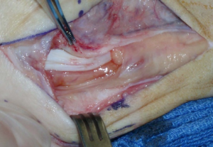 Peroneus tendon tear