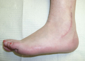 Healed tendon repair and calcaneal osteotomy (heel realignment)