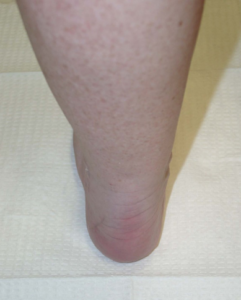 Improved heel alignment associated with original tendon tear