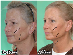 Facial Rejuvenation Surgery