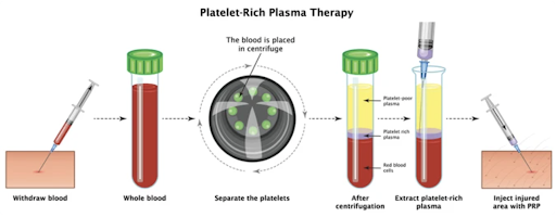 Platelet Rich Plasma