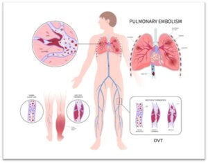 DVT Interventions