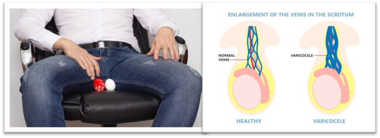 Varicocele Embolization