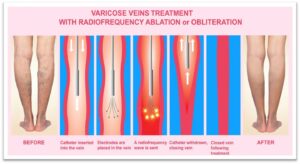 Ablation For Varicose Vein