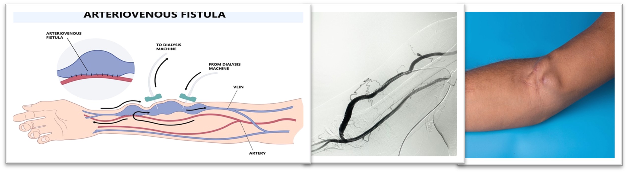 Dialysis Interventions