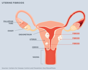 Uterine Fibroids