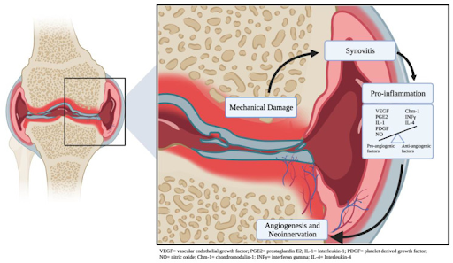 Knee Osteoarthritis