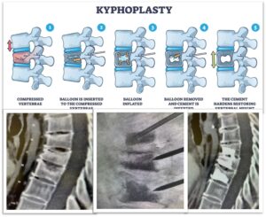 Spine Interventions