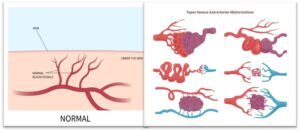 Vascular malformations Interventions