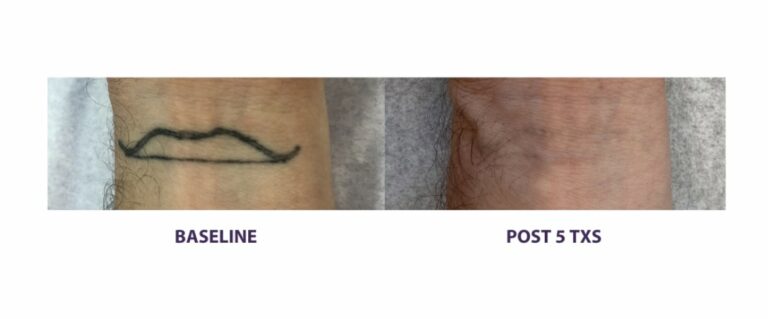 Laser Tattoo Removal