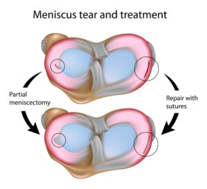 Surgical Treatment