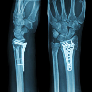 Wrist Fractures