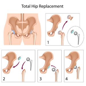 Total Hip Replacement