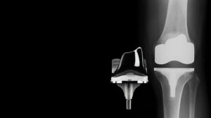 Total Knee Replacement