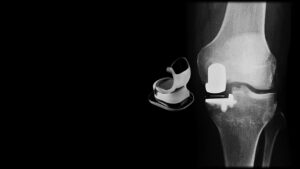 Partial Knee Replacement