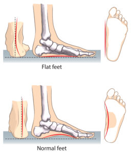 Treatment for PTTD & Adult Acquired Flatfoot