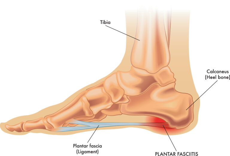 Treatment for Heel Pain & Plantar Fasciitis