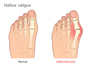 Bunion Deformities - Symptoms & Treatment