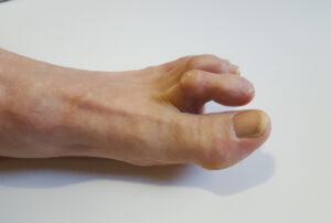 Toe Deformities - Treatment for Claw Toe & Hammer Toe