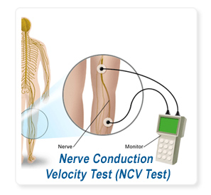 Nerve Conduction Velocity (NCV TEST)