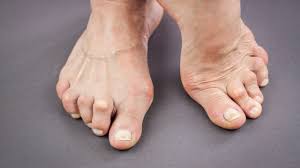  Arthritis of the Foot and Ankle