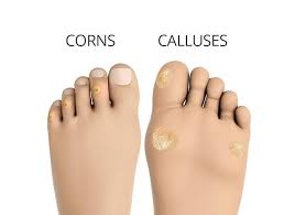 Corns & Callous Issues