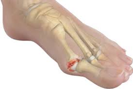 Hallux Rigidus