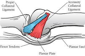 Plantar-Plate-Tear