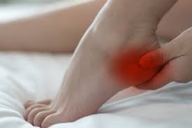 Plantar Fasciitis