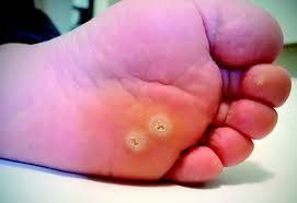  Warts